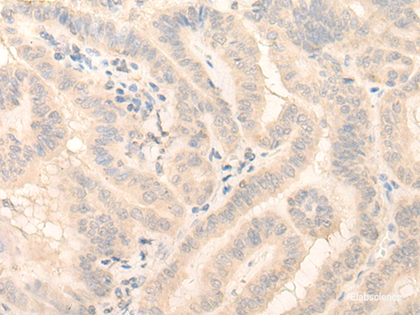 Immunohistochemistry of paraffin-embedded Human thyroid cancer tissue using HMBS Polyclonal Antibody at dilution of 1:25(×200)