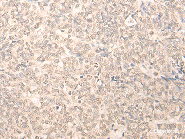 Immunohistochemistry of paraffin-embedded Human ovarian cancer tissue using RUVBL2 Polyclonal Antibody at dilution of 1:25(×200)