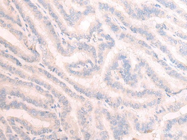 Immunohistochemistry of paraffin-embedded Human thyroid cancer tissue using TBC1D2 Polyclonal Antibody at dilution of 1:25(×200)