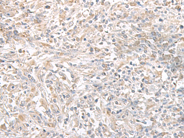 Immunohistochemistry of paraffin-embedded Human liver cancer tissue using PFKM Polyclonal Antibody at dilution of 1:50(×200)