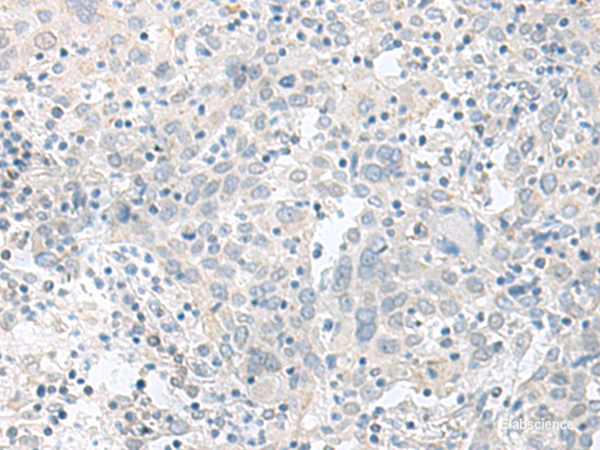 Immunohistochemistry of paraffin-embedded Human cervical cancer tissue using TIMM8A Polyclonal Antibody at dilution of 1:90(×200)