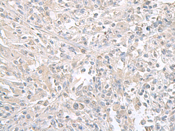Immunohistochemistry of paraffin-embedded Human liver cancer tissue using FXYD6 Polyclonal Antibody at dilution of 1:65(×200)