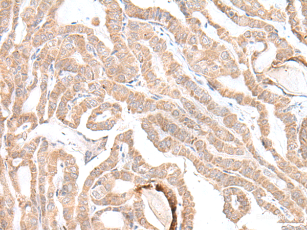 Immunohistochemistry of paraffin-embedded Human thyroid cancer tissue using PLGLB2 Polyclonal Antibody at dilution of 1:35(×200)