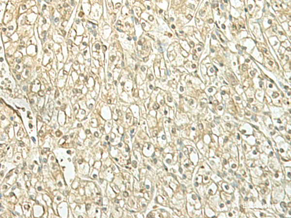 Immunohistochemistry of paraffin-embedded Human kidney cancer tissue using SPIRE1 Polyclonal Antibody at dilution of 1:60(×200)