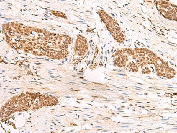 Immunohistochemistry of paraffin-embedded Human esophagus cancer tissue using HUS1 Polyclonal Antibody at dilution of 1:45(×200)
