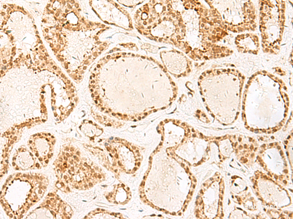 Immunohistochemistry of paraffin-embedded Human thyroid cancer tissue using PSPC1 Polyclonal Antibody at dilution of 1:25(×200)