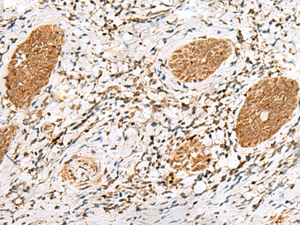 Immunohistochemistry of paraffin-embedded Human esophagus cancer tissue using NUP58 Polyclonal Antibody at dilution of 1:60(×200)