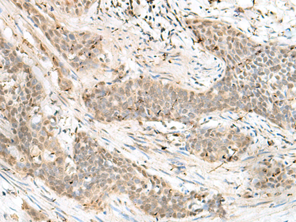 Immunohistochemistry of paraffin-embedded Human esophagus cancer tissue using LIG4 Polyclonal Antibody at dilution of 1:60(×200)