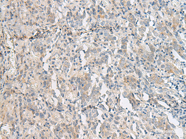 Immunohistochemistry of paraffin-embedded Human cervical cancer tissue using PCSK5 Polyclonal Antibody at dilution of 1:50(×200)