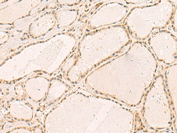 Immunohistochemistry of paraffin-embedded Human thyroid cancer tissue using RFX6 Polyclonal Antibody at dilution of 1:50(×200)