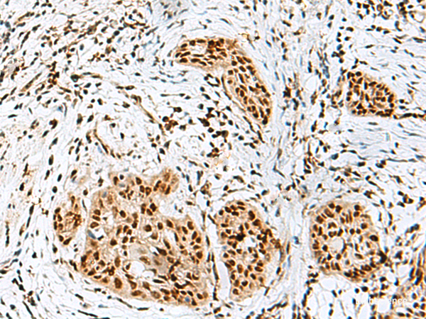 Immunohistochemistry of paraffin-embedded Human esophagus cancer tissue using RBM10 Polyclonal Antibody at dilution of 1:50(×200)