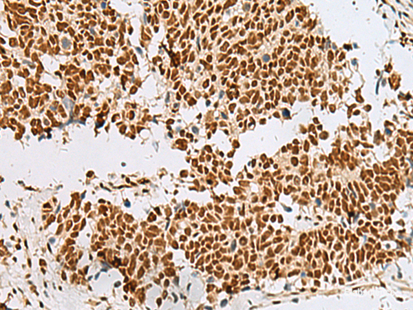 Immunohistochemistry of paraffin-embedded Human lung cancer tissue using RBM12 Polyclonal Antibody at dilution of 1:50(×200)