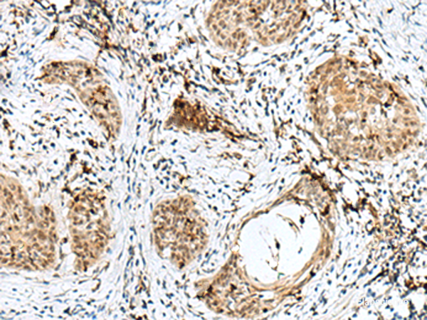 Immunohistochemistry of paraffin-embedded Human esophagus cancer tissue using RBM15 Polyclonal Antibody at dilution of 1:50(×200)