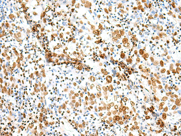 Immunohistochemistry of paraffin-embedded Human cervical cancer tissue using TCOF1 Polyclonal Antibody at dilution of 1:50(×200)