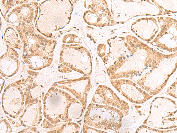 Immunohistochemistry of paraffin-embedded Human thyroid cancer tissue using RBM19 Polyclonal Antibody at dilution of 1:30(×200)