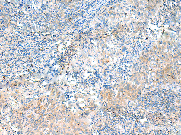 Immunohistochemistry of paraffin-embedded Human cervical cancer tissue using NID2 Polyclonal Antibody at dilution of 1:50(×200)