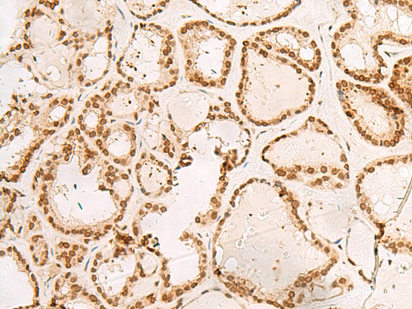 Immunohistochemistry of paraffin-embedded Human thyroid cancer tissue using POM121 Polyclonal Antibody at dilution of 1:40(×200)