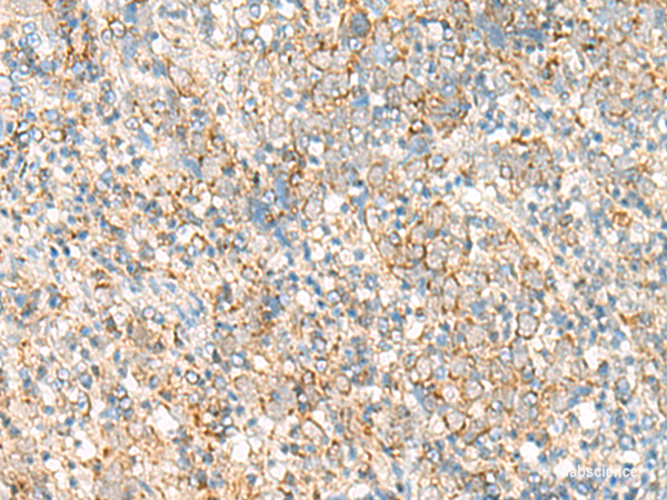 Immunohistochemistry of paraffin-embedded Human cervical cancer tissue using PSD4 Polyclonal Antibody at dilution of 1:50(×200)