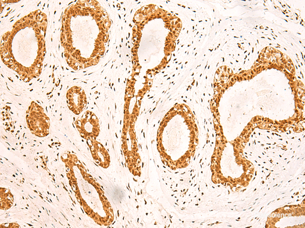 Immunohistochemistry of paraffin-embedded Human breast cancer tissue using ZNF471 Polyclonal Antibody at dilution of 1:50(×200)