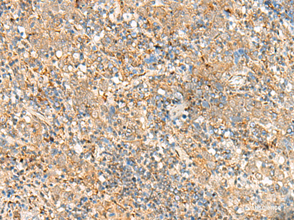 Immunohistochemistry of paraffin-embedded Human cervical cancer tissue using FKBP1A Polyclonal Antibody at dilution of 1:55(×200)