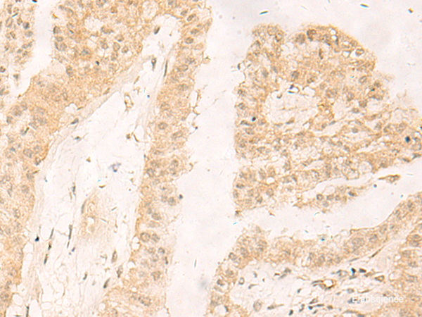 Immunohistochemistry of paraffin-embedded Human liver cancer tissue using RBX1 Polyclonal Antibody at dilution of 1:30(×200)