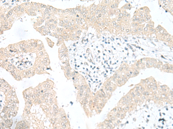 Immunohistochemistry of paraffin-embedded Human liver cancer tissue using SNRPD1 Polyclonal Antibody at dilution of 1:30(×200)