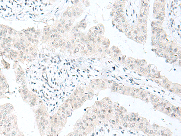 Immunohistochemistry of paraffin-embedded Human liver cancer tissue using ENSA Polyclonal Antibody at dilution of 1:70(×200)