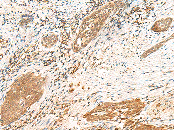 Immunohistochemistry of paraffin-embedded Human esophagus cancer tissue using POLR1D Polyclonal Antibody at dilution of 1:50(×200)