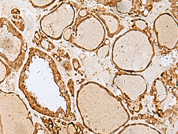 Immunohistochemistry of paraffin-embedded Human thyroid cancer tissue using LYRM1 Polyclonal Antibody at dilution of 1:40(×200)