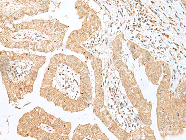 Immunohistochemistry of paraffin-embedded Human liver cancer tissue using BEX2 Polyclonal Antibody at dilution of 1:50(×200)
