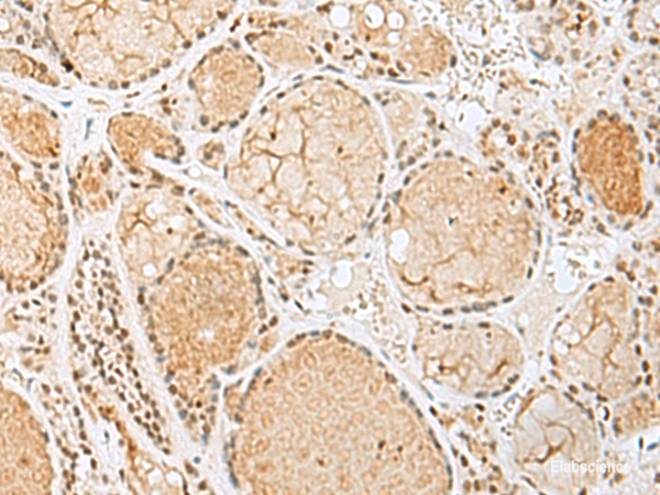 Immunohistochemistry of paraffin-embedded Human thyroid cancer tissue using HIST1H2BK Polyclonal Antibody at dilution of 1:60(×200)