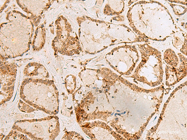 Immunohistochemistry of paraffin-embedded Human thyroid cancer tissue using H3F3B Polyclonal Antibody at dilution of 1:40(×200)
