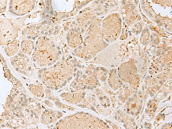 Immunohistochemistry of paraffin-embedded Human thyroid cancer tissue using GOLGA7 Polyclonal Antibody at dilution of 1:40(×200)
