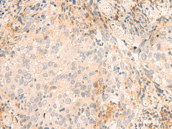 Immunohistochemistry of paraffin-embedded Human cervical cancer tissue using GSKIP Polyclonal Antibody at dilution of 1:45(×200)
