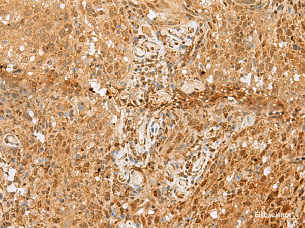 Immunohistochemistry of paraffin-embedded Human cervical cancer tissue using PNRC2 Polyclonal Antibody at dilution of 1:50(×200)