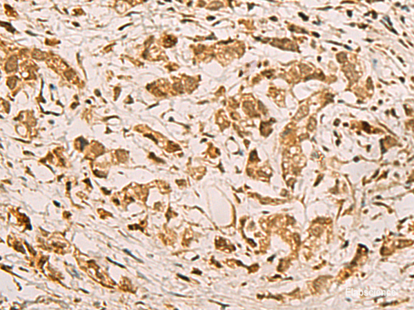 Immunohistochemistry of paraffin-embedded Human gastric cancer tissue using ZMAT4 Polyclonal Antibody at dilution of 1:65(×200)