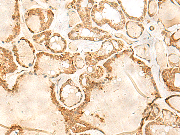 Immunohistochemistry of paraffin-embedded Human thyroid cancer tissue using JPT1 Polyclonal Antibody at dilution of 1:35(×200)