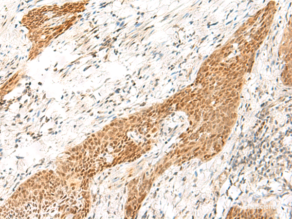 Immunohistochemistry of paraffin-embedded Human esophagus cancer tissue using RPS27A Polyclonal Antibody at dilution of 1:35(×200)