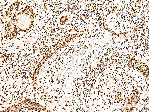 Immunohistochemistry of paraffin-embedded Human esophagus cancer tissue using ILF3 Polyclonal Antibody at dilution of 1:40(×200)