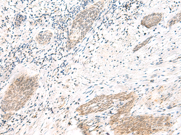Immunohistochemistry of paraffin-embedded Human esophagus cancer tissue using ARL2BP Polyclonal Antibody at dilution of 1:50(×200)