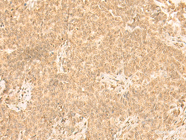 Immunohistochemistry of paraffin-embedded Human ovarian cancer tissue using ST8SIA4 Polyclonal Antibody at dilution of 1:50(×200)