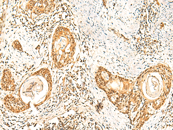 Immunohistochemistry of paraffin-embedded Human esophagus cancer tissue using ZNF580 Polyclonal Antibody at dilution of 1:75(×200)