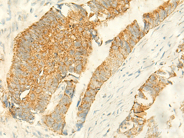 Immunohistochemistry of paraffin-embedded Human colorectal cancer tissue using MPV17 Polyclonal Antibody at dilution of 1:50(×200)