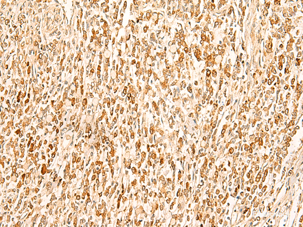 Immunohistochemistry of paraffin-embedded Human gastric cancer tissue using SMUG1 Polyclonal Antibody at dilution of 1:50(×200)