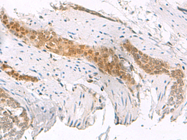 Immunohistochemistry of paraffin-embedded Human esophagus cancer tissue using SCAND1 Polyclonal Antibody at dilution of 1:50(×200)