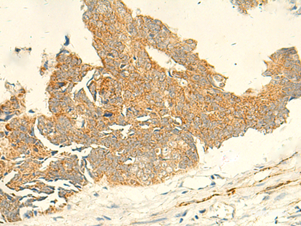 Immunohistochemistry of paraffin-embedded Human colorectal cancer tissue using TMEM9 Polyclonal Antibody at dilution of 1:50(×200)