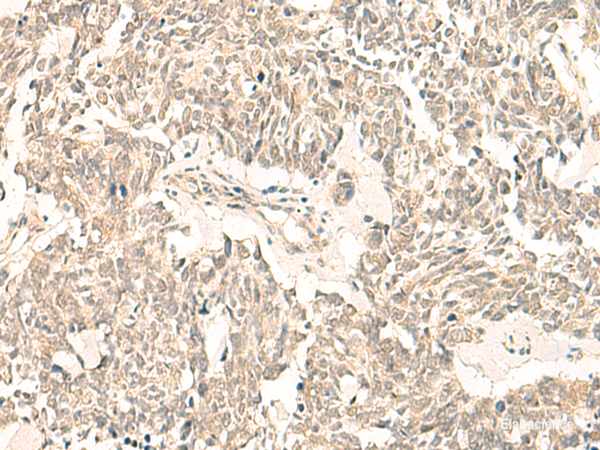 Immunohistochemistry of paraffin-embedded Human lung cancer tissue using GINS2 Polyclonal Antibody at dilution of 1:50(×200)