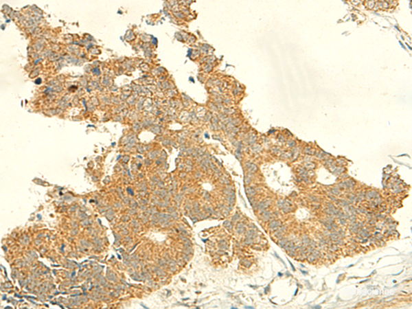 Immunohistochemistry of paraffin-embedded Human colorectal cancer tissue using IFT27 Polyclonal Antibody at dilution of 1:50(×200)