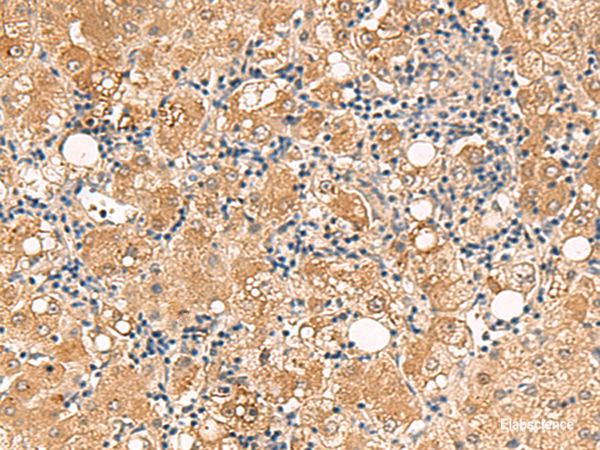Immunohistochemistry of paraffin-embedded Human liver cancer tissue using FUNDC2 Polyclonal Antibody at dilution of 1:60(×200)