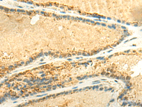 Immunohistochemistry of paraffin-embedded Human thyroid cancer tissue using EEF1AKMT2 Polyclonal Antibody at dilution of 1:50(×200)